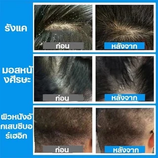 แชมพูสระผมสะอาด แชมพูแก้คัน นี้ช่วยขจั ดรังแค กำจัดเชื้อรา สะเก็ดเงิน ลอก พร้อมซ่อมแซมปลายผมแตก และทำให้ผมเรียบลื่น500ml