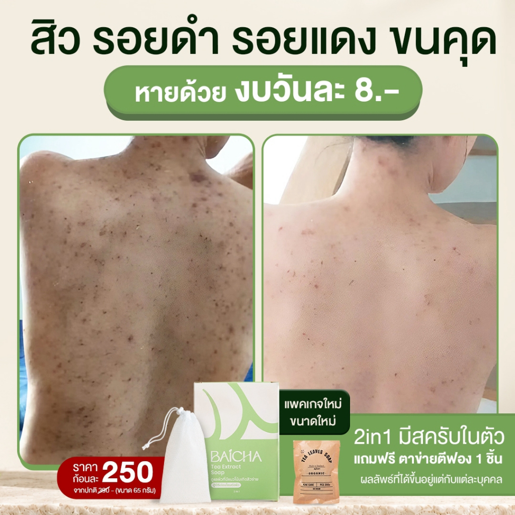 สบู่รักษาสิวที่หลัง หน้าอก ใบหน้า สูตรแพทย์แผนไทย ขนาด65กรัม สบู่ใบชา สบู่ใบชารักษาสิว แพคเกจใหม่