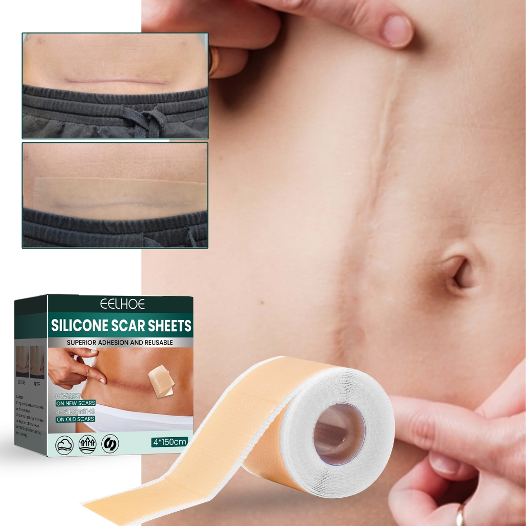 EELHOE แผ่นแผลเป็นซิลิโคน Silicone Scar Tape 4cm*150cm เทปซิลิโคนสำหรับรอยแผลเป็น, แผ่นซิลิโคนสำหรับรอยแผลเป็น