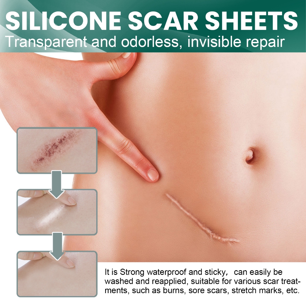 EELHOE แผ่นแผลเป็นซิลิโคน Silicone Scar Tape 4cm*150cm เทปซิลิโคนสำหรับรอยแผลเป็น, แผ่นซิลิโคนสำหรับรอยแผลเป็น - รูปที่ 2
