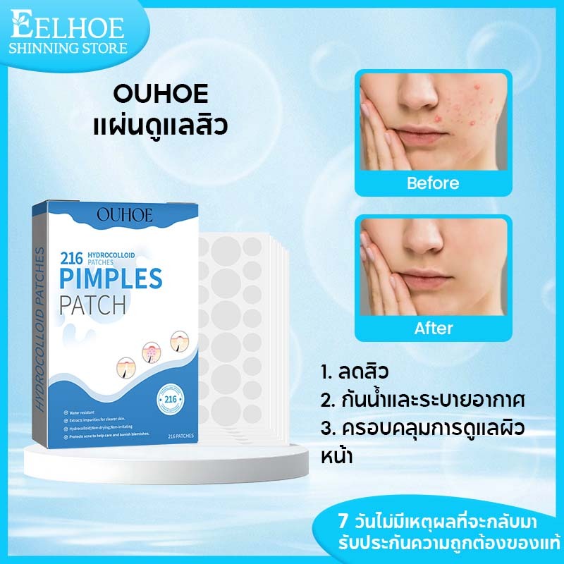OUHOE แผ่นแปะสิว แผ่นแปะสิวใส่งัด แปะสิว สิวอุดตัน  แผ่นบางใสแปะกลางวัน ดูดสิวอุดตันไม่ทิ้งรอยแดง