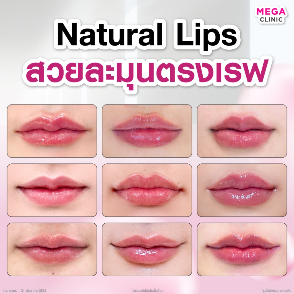 [E-voucher] โปรเหมาฟิลเลอร์ปาก 1 CC + ดริปผิวกระจ่างใส (ปกติ 11,800.-) MEGA CLINIC เมกะคลินิก