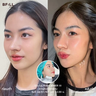 BFiLL โปรแกรม Ultraformer ยกกระชับลึกถึงชั้น SMAS, เก็บเหนียง by Doctor ไม่รวมยาชา Free Therma Lift บีฟิล คลินิก