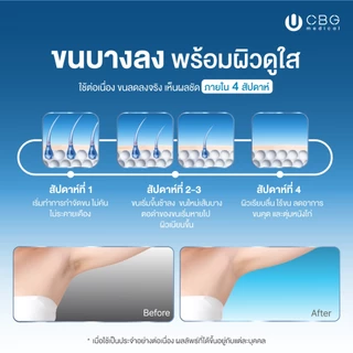 NEW! CBG Medical IPL Classic SONA II white เครื่องเลเซอร์กำจัดขนถาวร ไม่จำกัดชอต พร้อมระบบเย็น 10°C [WNIP2]
