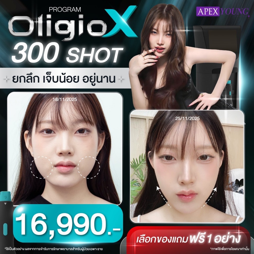 [E-Voucher] APEX โปรแกรม Oligio X หน้าเรียว หน้ายุง 300 Shot ยกกระชับ ลดไขมัน เลือกของแถมฟรี1อย่าง