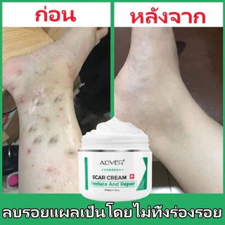 [ของแท้ 100%] ALIVER ครีมลดรอยแผลเป็น แผลเป็นนูนหนา แผลเป็นถลอก เร่งการซ่อมแซมให้ผิว ครีมแผลเป็น ลดแผลเป็น ยาทาแผลเป็น