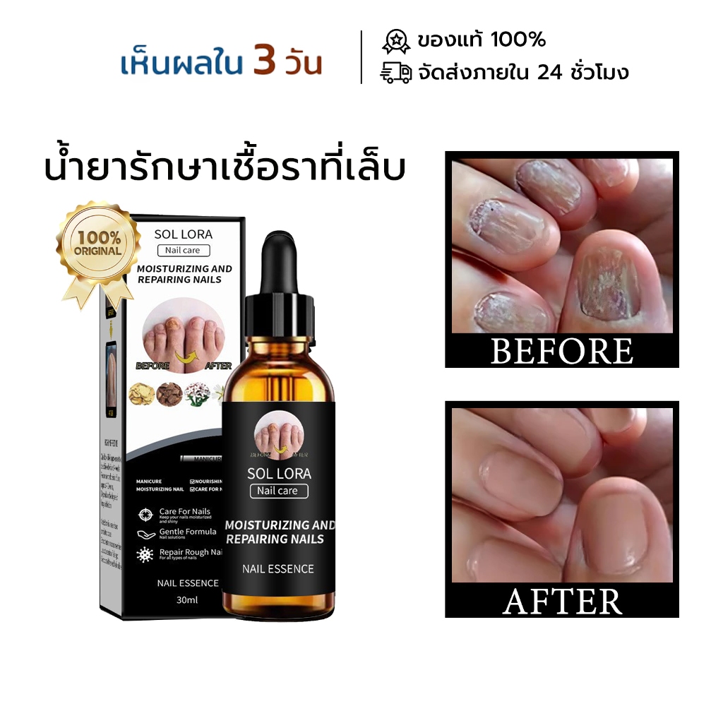 [ตัวแรง!] เซรั่มรักษาเชื้อราที่เล็บ ซ่อมแซมเล็บเหล็บ/เล็บเสีย เห็นผลไวใน 7 วัน ดูแลเล็บแตก nail repair 10ml