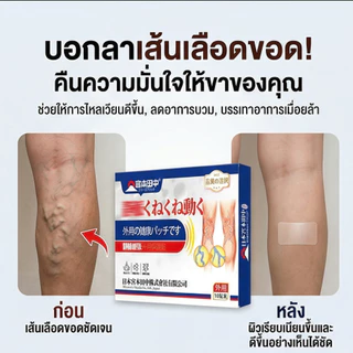 Varicose Vein Treatment Patch แผ่นแปะเส้นเลือดขอด ขาสวย ลบเส้นเลือดขอด กลับคืนสุขภาพเท้า 10ชิ้น