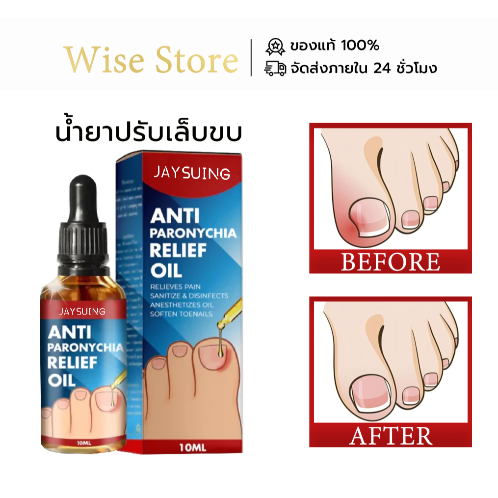 Jaysuing น้ำมันบรรเทาเล็บขบ ฆ่าเชื้อ ลดปวด ทำให้เล็บนุ่ม ซ่อมแซมเล็บติดเชื้อ รักษาเชื้อรา 10ml
