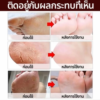 ครีมทาส้นทาแตก ครีมทาเท้าแตก ที่ขัดเท้าแตก ครีมบำรุงเท้า เท้าแตก ดูแลมือ ขัดผิวหนัง แห้ง หยาบ หนัง