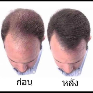 โลชั่นปลูกผม NHH-5 บำรุงรากผม ลดรังแค กลิ่นหอมสดชื่น