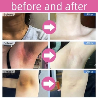 Kojic Acid ครีมบำรุงผิว 50ml ทารักแร้ ขาหนีบ เข่า คอดำ ปรับผิวให้ขาวกระจ่างใส