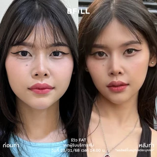 BFiLL โปรแกรม Fat ฉีดแฟต ลดไขมัน ลดแก้ม ลดเหนียง ปรับรูปหน้า หน้าเรียว กรอบหน้าชัด ลดสัดส่วน ลดไขมันเฉพาะจุด ผิวกระชับ