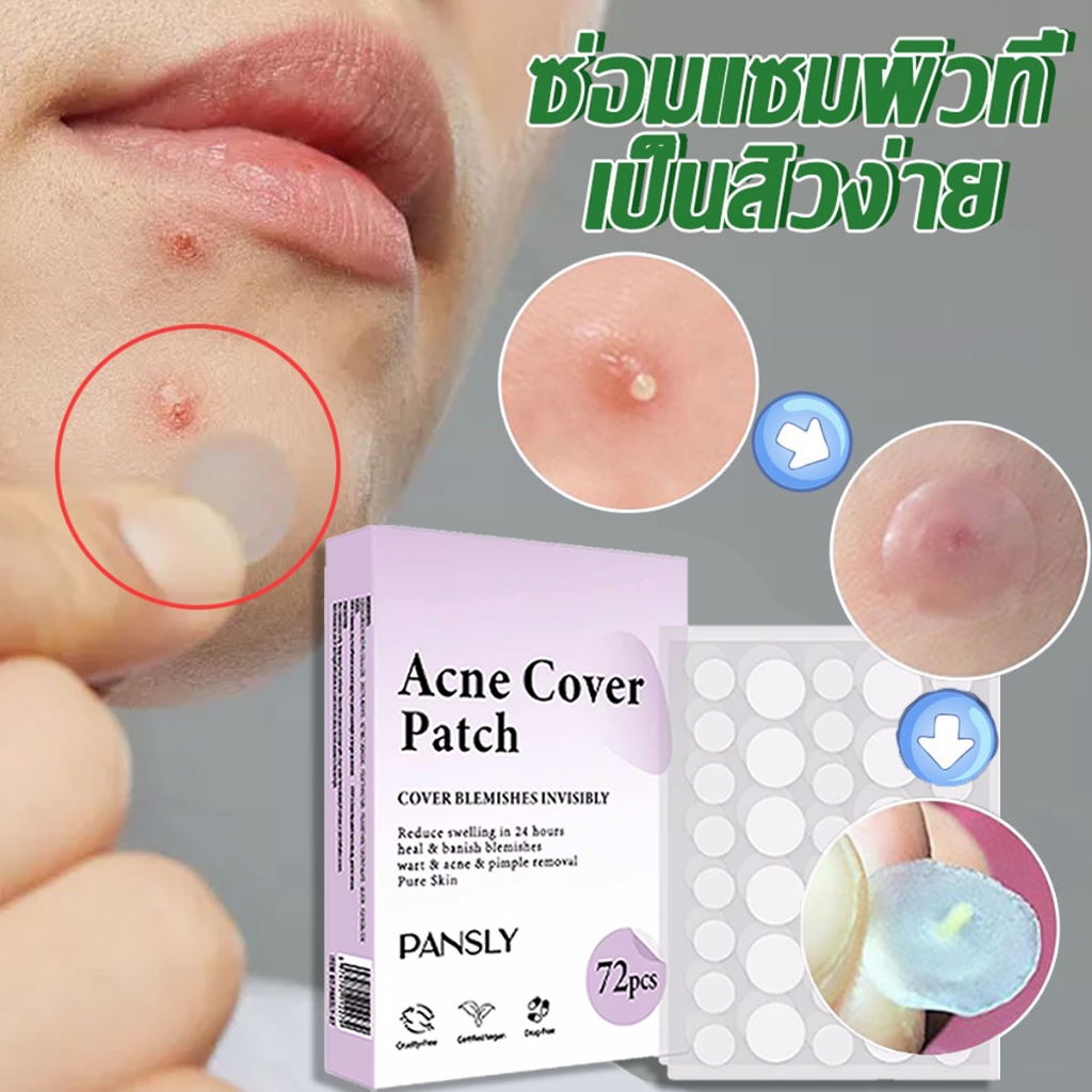 แผ่นปิดสิวใส มองไม่เห็น ทาเครื่องสำอางทับได้ ติดทน กันน้ำกันเหงื่อ เหมาะสิวขนาดเล็ก-ใหญ่ สูตรอ่อนโยนต่อผิว