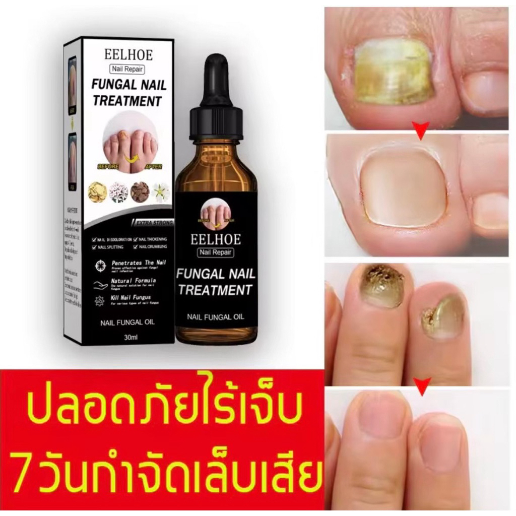 น้ำยาบำรุงเล็บเชื้อรา 30มล.
