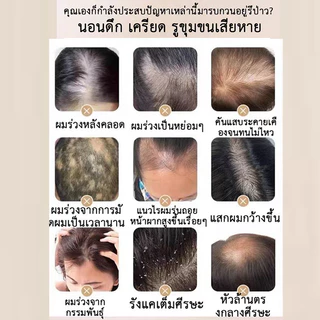 【ของแท้จากร้านออฟฟิเชียล】SAFEMILDแชมพูป้องกันผมร่วงช่วยบรรเทาอาการคันหนังศีรษะและลดปัญหาผมบางได้อย่างมีประสิทธิภาพ