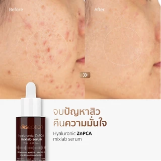 Ekseption Hyaluronic ZnPCA เซรั่มสยบสิว คุมมัน สำหรับผิวมันและเป็นสิวง่าย ขนาด 75 ML.