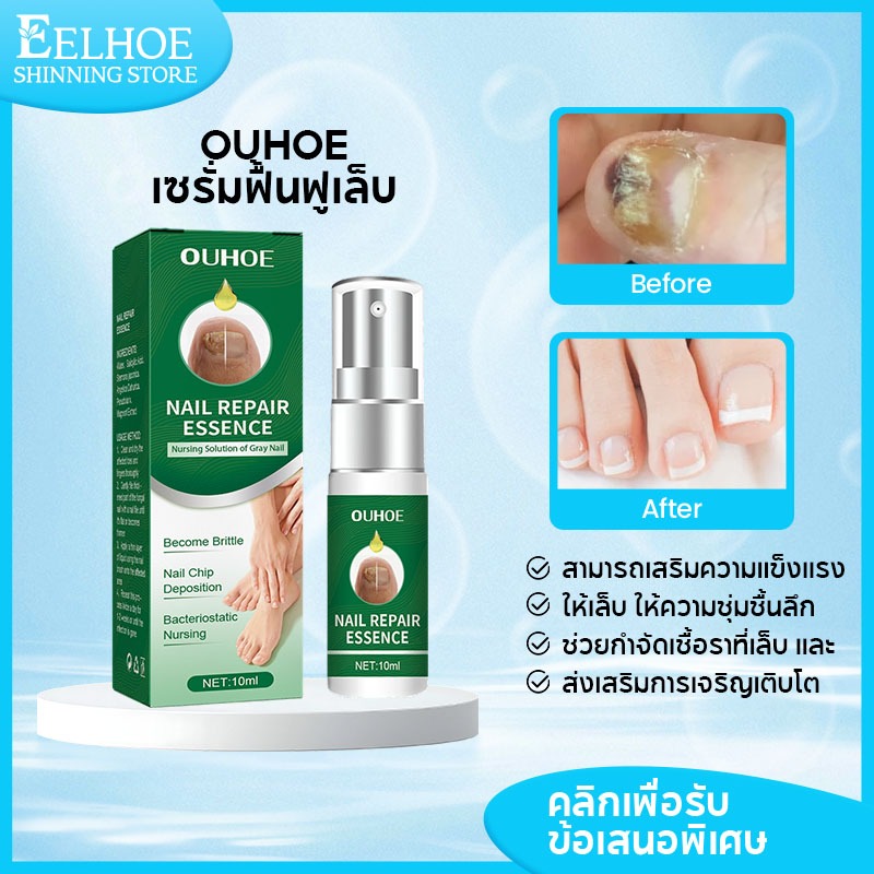 ​OUHOE เซรั่มบำรุงเล็บเชื้อราอย่างมืออาชีพ เล็บเหลือง-หนา-เปราะ ภายใน ฟื้นฟูสุขภาพเล็บให้แข็งแรง10ml