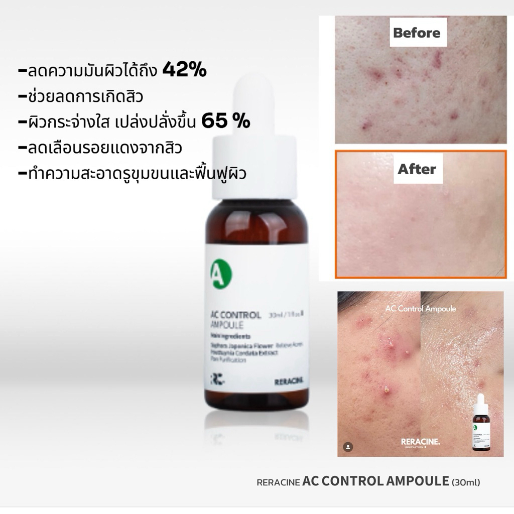 [แอมพูลลดสิว รักษาสิว แก้ปัญหาสิว] Reracine A.C. Control Ampoule (30ml)