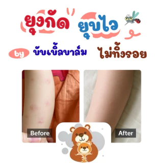 [ซื้อครบ400.-ฟรีโลชั่นกันยุง]บาล์มทายุงกัด ลดคัน ลดรอยดำ ขาลาย ขนาดพกพา 6 กรัม (Exp: 11/2027)