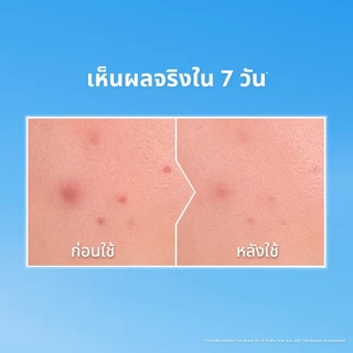 นีเวีย ไมเซล่า วอเตอร์ เดอร์มา แอคเน่ แคร์ 400 มล. และนีเวีย เดอร์มา แอคเน่ แคร์ เคลนเซอร์เจลทูโฟม 90 มลNIVEA