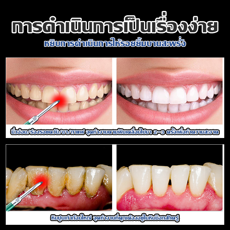 HOPTECH ชุดแปรงสีฟัน เครื่องล้างฟันแบบอัลตราโซนิค เครื่องทำความสะอาดฟันไฟฟ้า ทำความสะอาดหินปูน การฟอกสีฟัน - รูปที่ 6