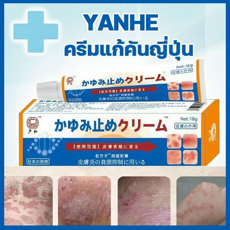 ครีมป้องกันเชื้อรา ครีมแก้คัน ครีมสะเก็ดเงิน บรรเทาอาการคัน ที่มีประสิทธิภาพกับการติดเชื้อที่เชื้อรา กลาก ผื่น ครีมบํารุ