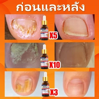 เห็นผลภายใน7วัน🔥เซรั่มบำรุงเล็บ ครีมซ่อมเล็บ ช่วยให้เล็บกลับมาแข็งแรง ครีมบำรุงเล็บ ยาเชื้อราเล็บ เซรั่มรักษาเล็บ 30ml