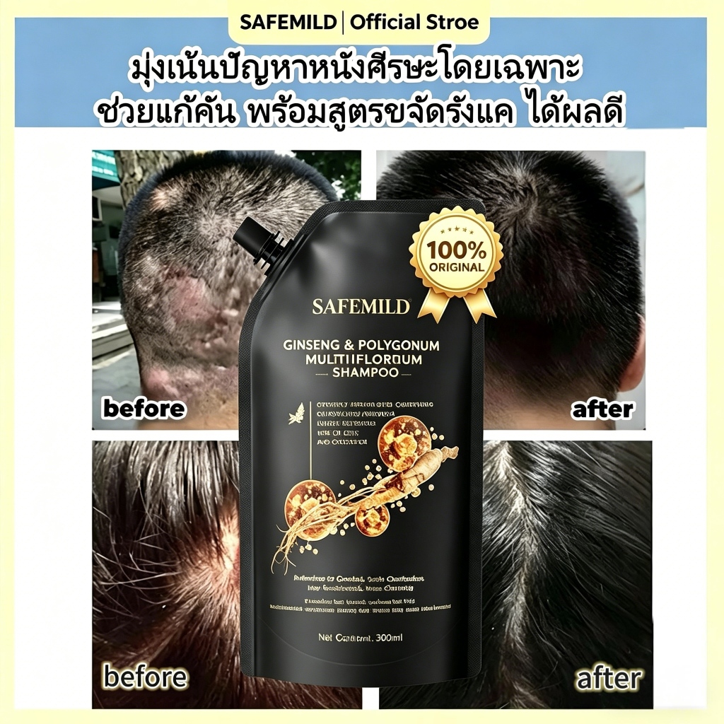 (สูตรสำหรับหนังศีรษะแพ้ง่าย) ยาสระผมสูตรอ่อนโยน 300ML ขจัดรังแค แก้คัน ลดอักเสบหนังศีรษะ ฟื้นฟูหนังศีรษะ