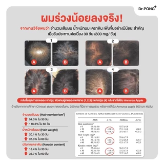 [ช้อปครบ รับฟรี] [ขายดี!] Dr.Pong ANA-X 30 อาหารเสริมยืดวงจรเส้นผม ลดผมร่วง ผมบาง เพิ่มจำนวน เพิ่มน้ำหนักเส้นผม
