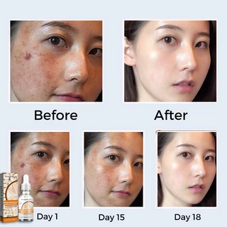 ครีมทาฝ้า 30ml ขจัดฝ้ากระ จุดดำ ผิวหน้าขาวใส