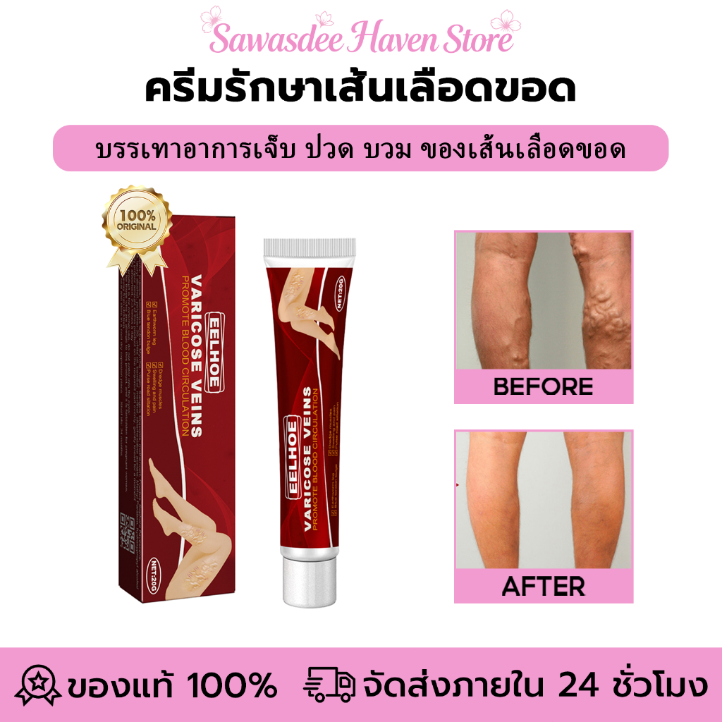 EELHOE ครีมรักษาเส้นเลือดขอด ส่งเสริมการไหลเวียนโลหิต บรรเทาอาการเจ็บ ปวด บวม ของเส้นเลือดขอด