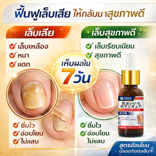 7 วัน ฆ่าเชื้อแบคทีเรีย เซรั่มบำรุงเล็บ รักษาเชื้อราเล็บ รักษาเล็บขบ ฆ่าเชื้อราที่เล็บ น้ำยาบำรุงเล็บ เชื้อราที่เล็บ