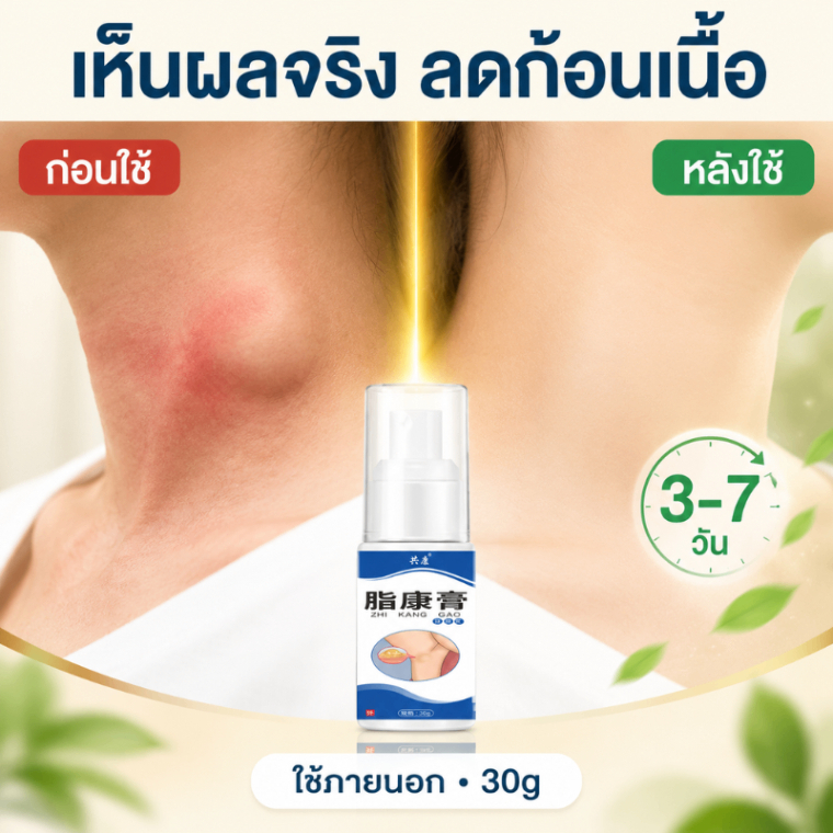 【ลดก้อนใต้ผิวหนังและก้อนเล็กๆ】ครีมบำรุงผิว 30g ช่วยลดก้อนใต้ผิวหนังและก้อนเล็กๆบนผิว