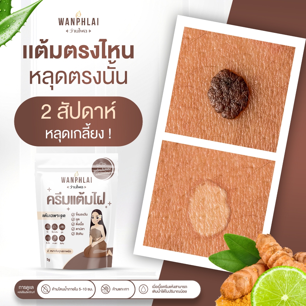 ครีมกำจัดไฝ ว่านไพล ขี้แมลงวัน ติ่งเนื้อ หูด ตาปลา แก้ปัญหา กระ สิวหิน ครีมแต้มไฝว่านไพล ไฝ หูด จี้ไฝ แต้มไฝ - รูปที่ 2