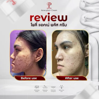 Polie Acne plus cream❤️ ครีมบำรุงผิวหน้า 10 g (พร้อมส่ง)