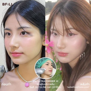 BFiLL โปรแกรม Ultraformer ยกกระชับลึกถึงชั้น SMAS, เก็บเหนียง by Doctor ไม่รวมยาชา Free Therma Lift บีฟิล คลินิก