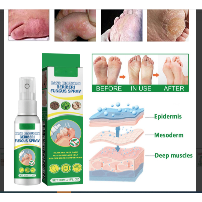 HAND RINGWORM BERIBERI SPRAY สเปรย์ฉีดเท้าฆ่าเชื้อรา-บรรเทาอาการคัน แสบร้อน และผิวลอกบริเวณเท้า