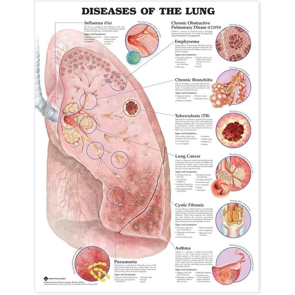 แผ่นโปสเตอร์ Diseases of the Lung Anatomical Chart (Paper) ed1/2005