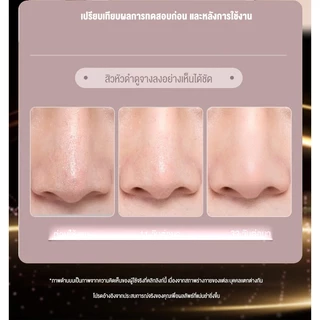 Langton เครื่องดูดสิวไฟฟ้า ปรับระดับได้ ดูดสิวเสี้ยน สิวอุดตัน สิ่งสกปรก สุดคุ้ม! แถมฟรีหัวดูด 5 ชิ้น