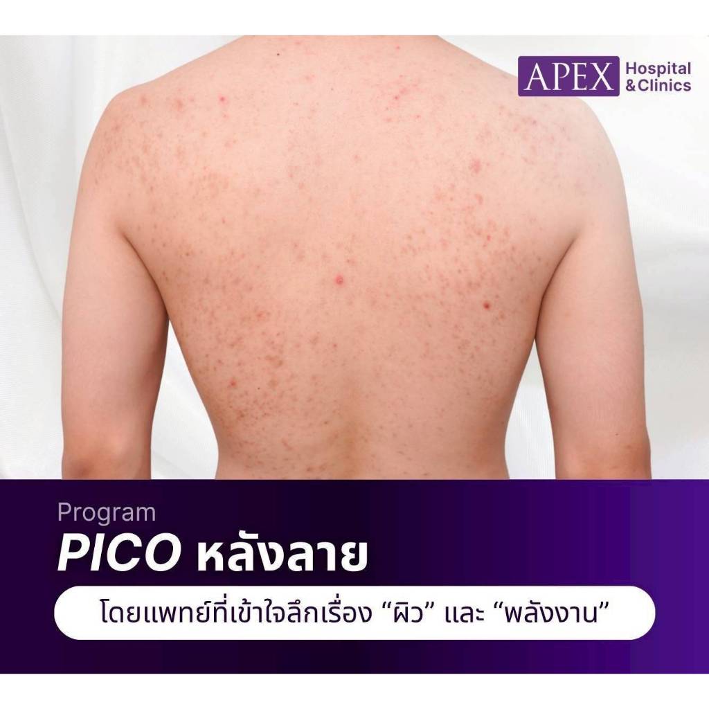 [E-Voucher] APEX โปรแกรม Pico หลัง by แพทย์ เลเซอร์ลดรอย หลังบน หรือ หลังล่าง ทดลอง 2,500 บาท