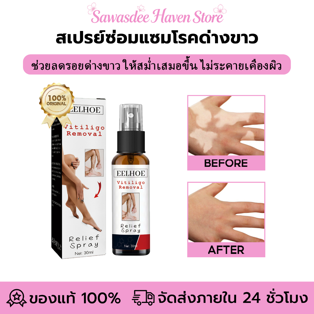 EELHOE สเปรย์รักษาด่างขาว ช่วยลดรอยด่างขาว ให้สม่ำเสมอขึ้น ไม่ระคายเคืองผิว บรรเทาอาการด่างขาว กําจัดเม็ดสี จุดด่างดํา