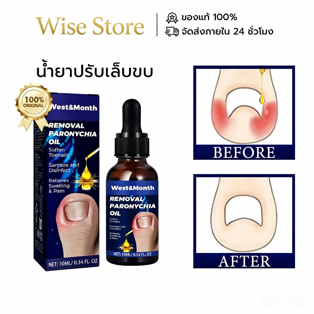 West&Month น้ํายาปรับเล็บขบ ปรับเล็บขบ โรคติดเชื้อที่ขอบเล็บ