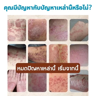 🌿 หยุดคันเร็ว ช่วยยับยั้งเชื้อรา บรรเทาอาการคันและผิวลอก เนื้อครีมบางเบา ครีมแก้เชื้อรา(18g)