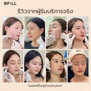 BFiLL โปรแกรม Botox Nabota โบท็อกซ์กราม ลดกราม ลิฟท์หน้า กรอบหน้าชัด ปรับรูปหน้าเรียว ออกฤทธิ์เร็ว ดื้อยาน้อย เหมา 100U