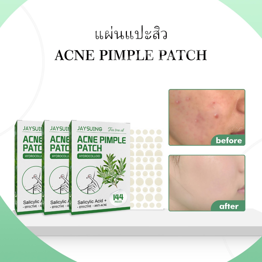 Jaysuing แผ่นแปะสิว แผ่นแพทช์แปะรักษาสิว แผ่นดูดสิว ช่วยลดอาการอักเสบให้ยุบไว กันน้ํา ระบายอากาศ แผ่นแปะดูดซับสิว