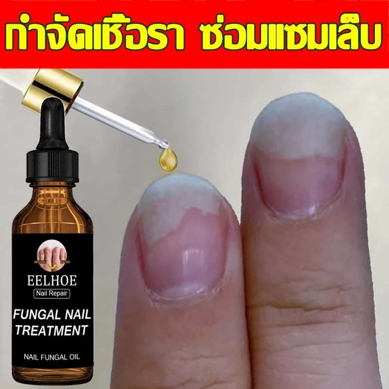 ห็นผลภายใน7วัน เอ็สเซ้นซ่อมแซมเล็บเสีย รักษารคเชื้อราที่เล็บ เล็บพัง เล็บขบ เซรั่มบำรุงเล็บ น้ำมันบำรุงเล็บ ดูแลเล็บ