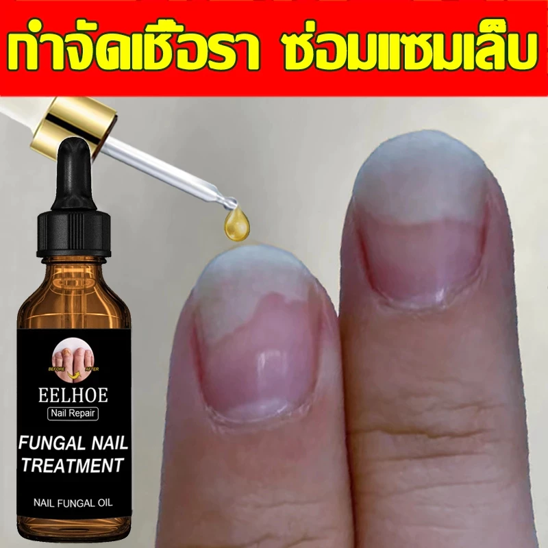 ห็นผลภายใน7วัน เอ็สเซ้นซ่อมแซมเล็บเสีย รักษารคเชื้อราที่เล็บ เล็บพัง เล็บขบ เซรั่มบำรุงเล็บ น้ำมันบำรุงเล็บ ดูแลเล็บ