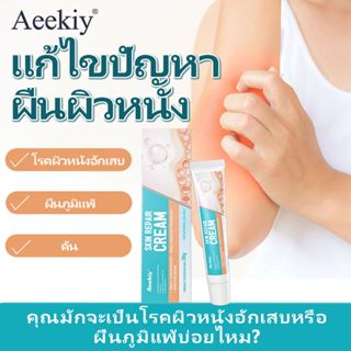 Aeekiy ครีมสมุนไพรแก้เอ็กซีมา กลาก ผื่นคัน แดง ปลอดสเตียรอยด…