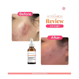 (สินค้าพร้อมส่ง) MD Formula Brightening Serum Tranexamic Acid 2.5%, Niacinamide 4% เซรั่มเปิดกลไกสลายฝ้า กระ